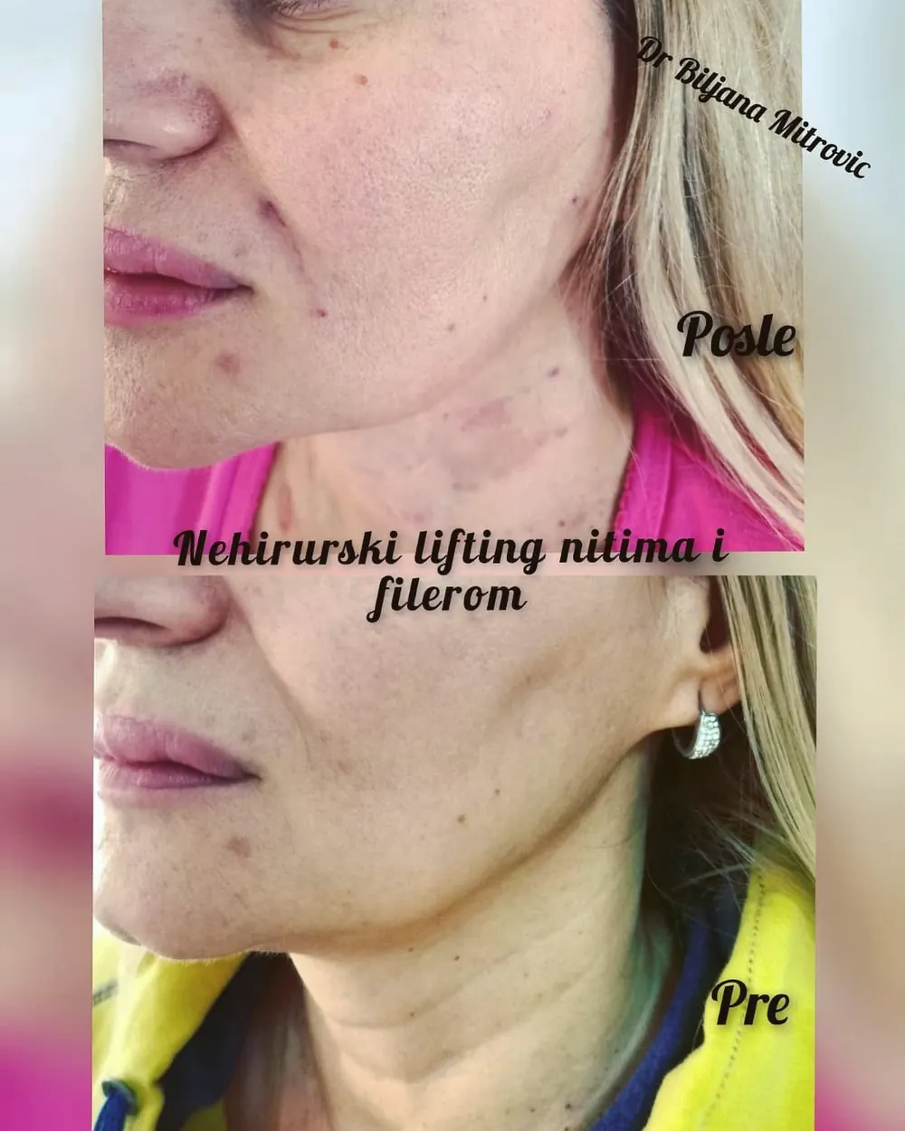 Niti za nehirurški lifting